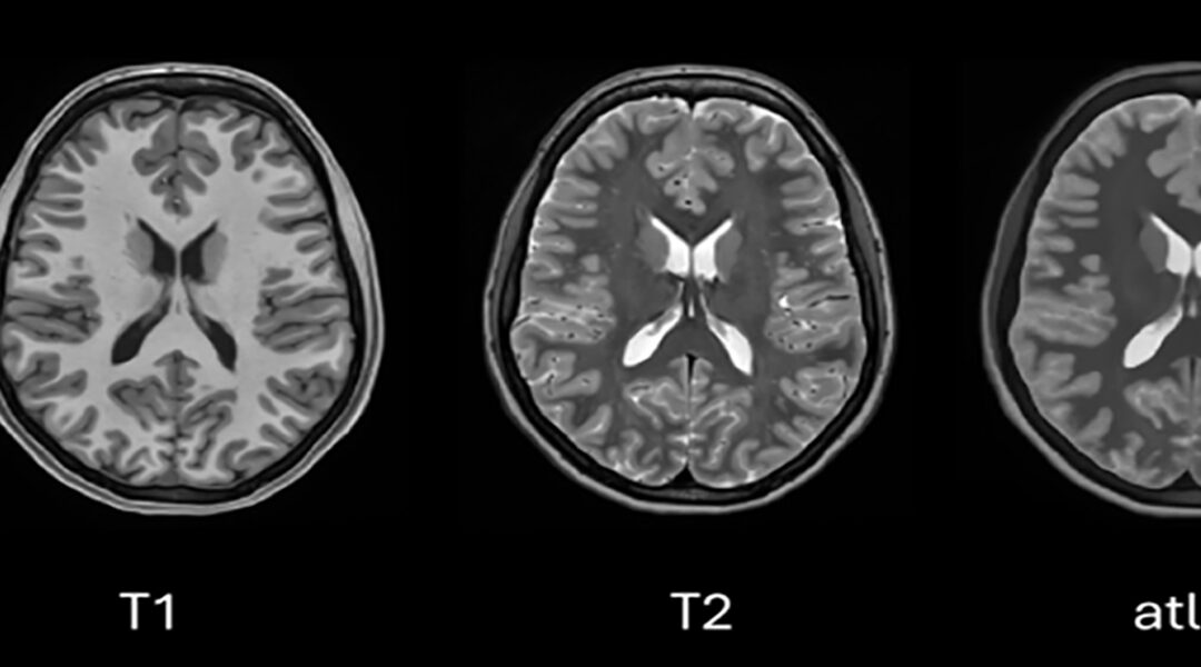 A new AI method enhances radiological imaging for neurological diseases