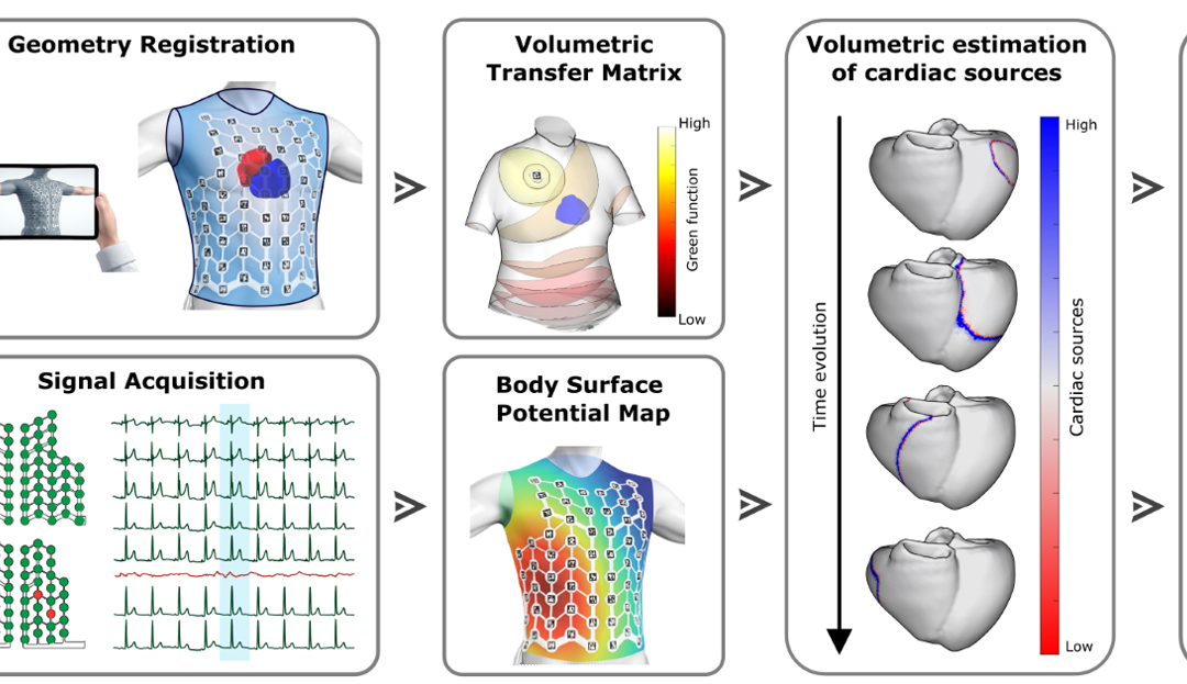 First complete heart mapping technology for a global view of cardiac arrhythmias in a single heartbeat