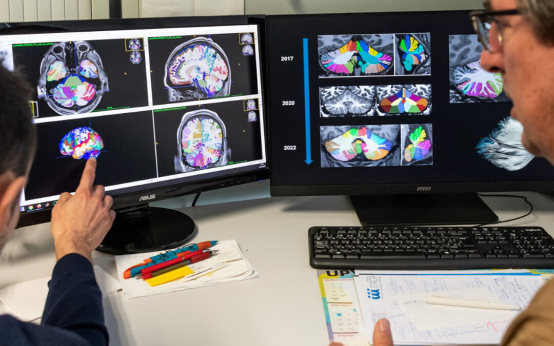 The volBrain platform helps improve the diagnosis and research of epilepsy