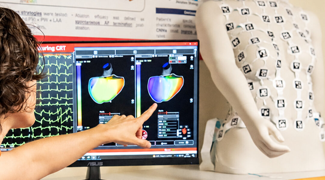Atrial cardiomyopathy